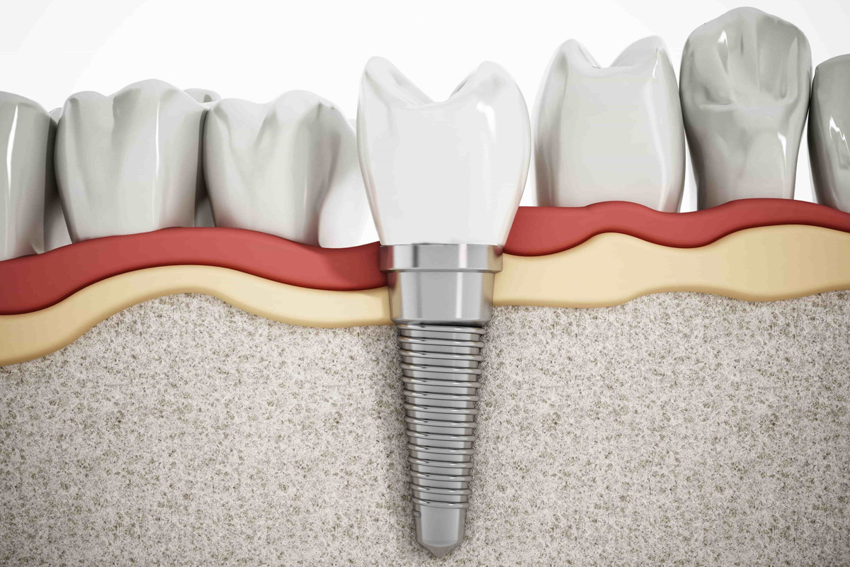 Are Dental Implants Hard to Take Care Of at Esthetique Dental in keller