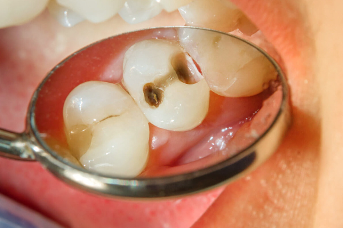 Dental Caries Crisis at Esthetique Dental in keller