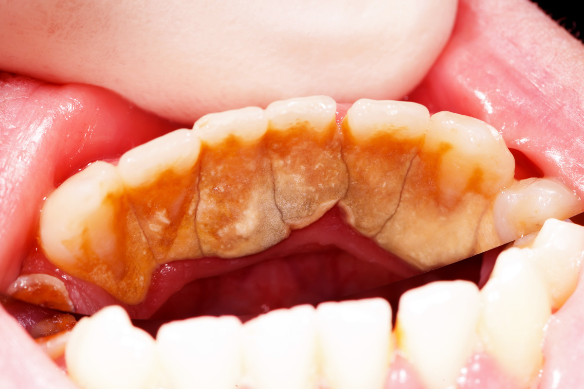 Dangers of Dental Plaque at Esthetique Dental in keller
