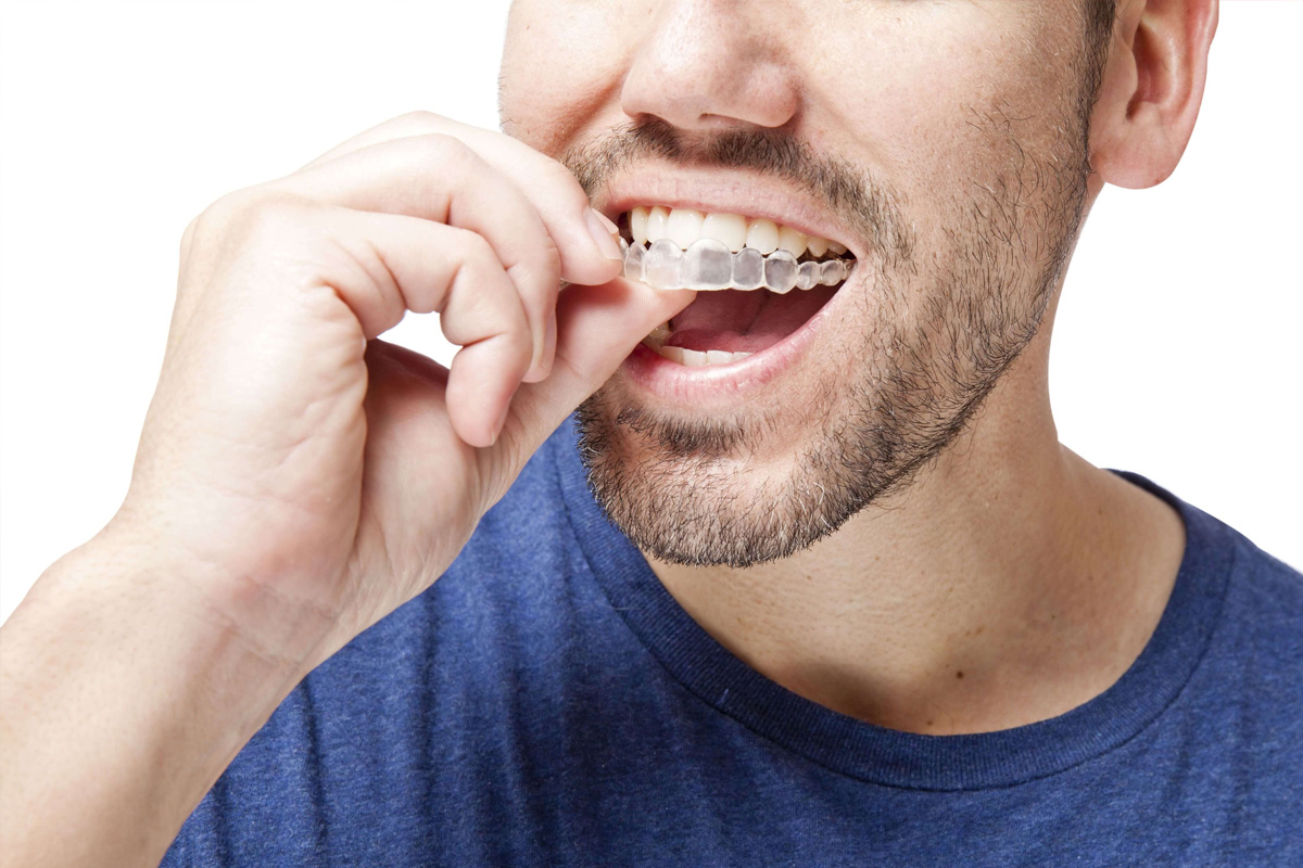 invisalign-&-cavities at Esthetique Dental in keller