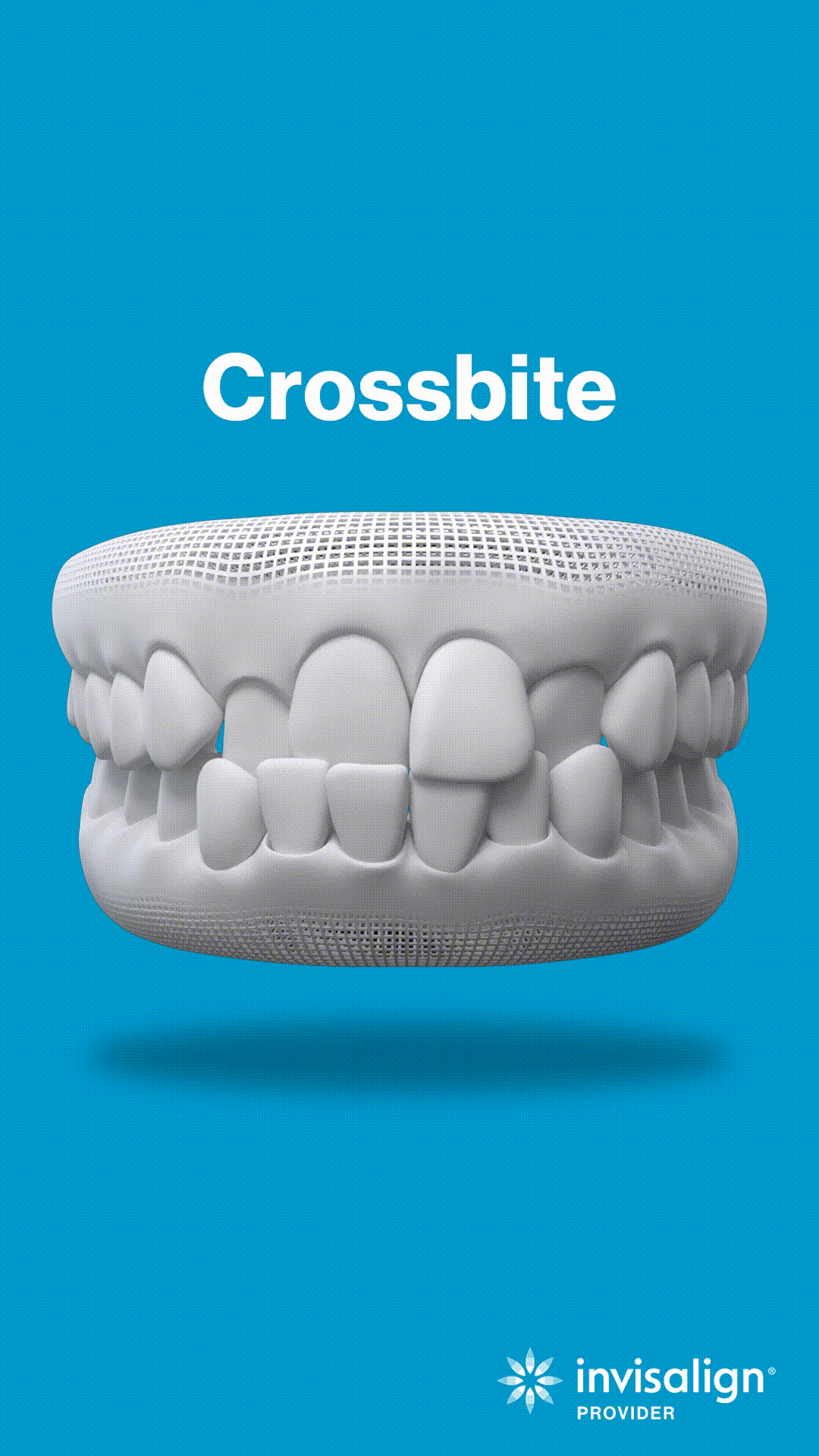 Crossbite dental model showing misaligned teeth on blue background for Invisalign treatment.