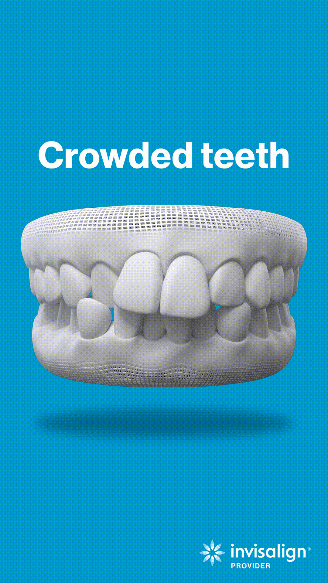 3D dental model showing crowded teeth on blue background with Invisalign branding