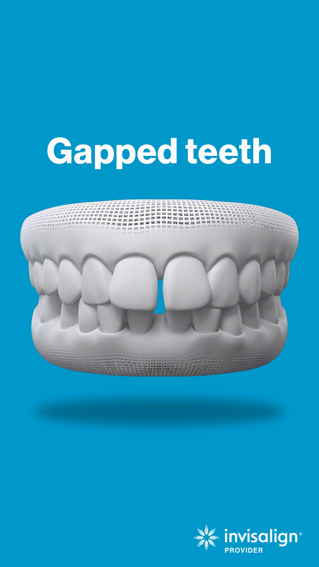 3D dental model showing gapped teeth with space between upper front teeth on blue background.