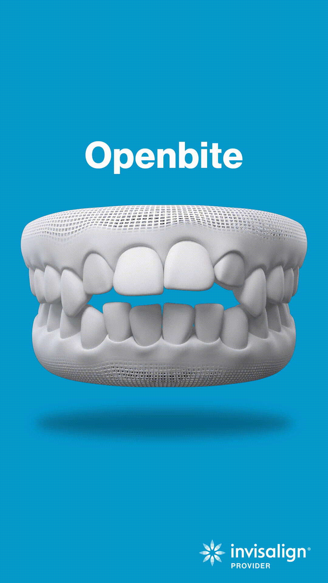 Openbite dental model showing teeth alignment issue against blue background with Invisalign logo.