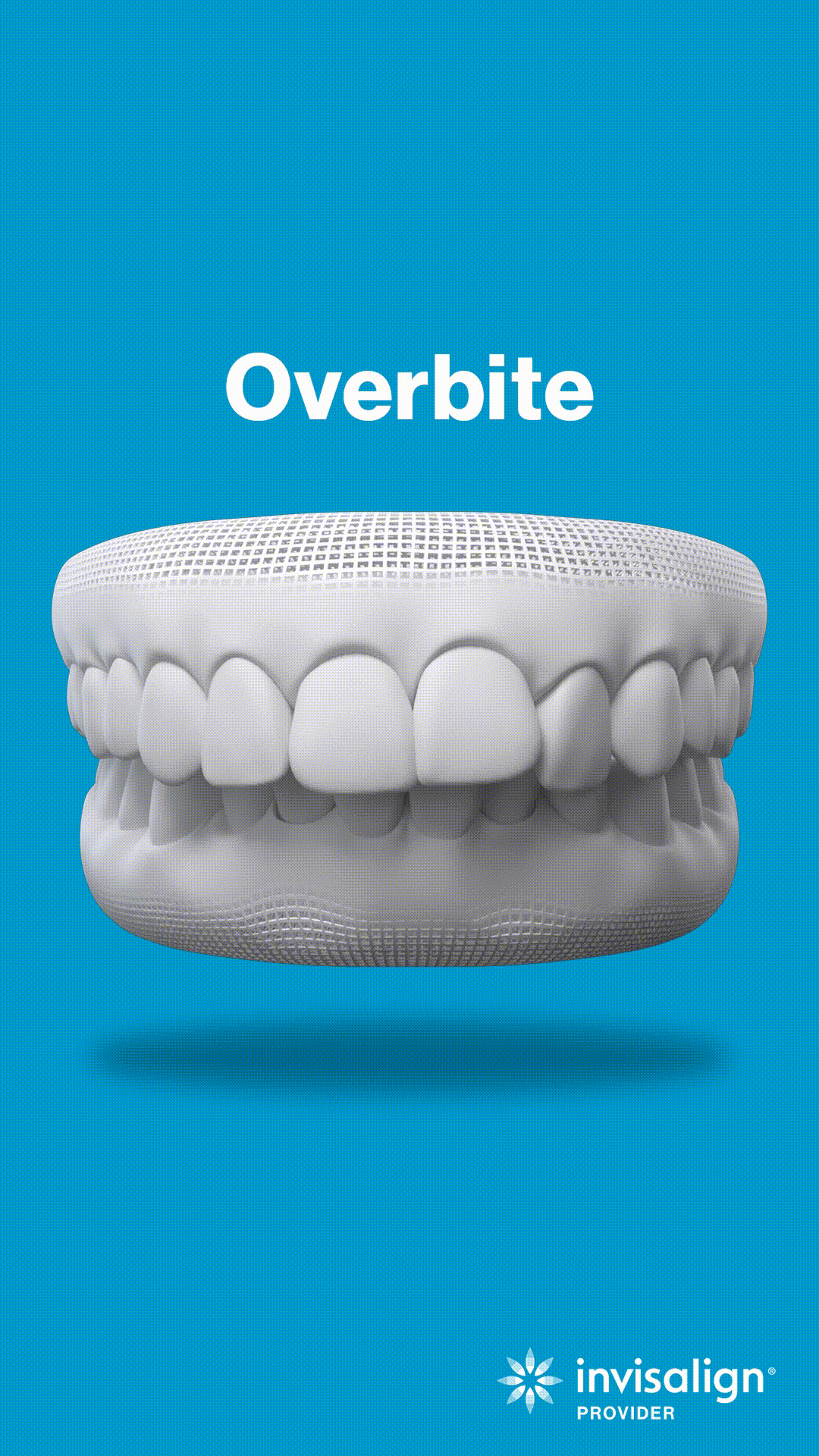 3D dental model showing overbite condition with upper teeth overlapping lower teeth on blue background.