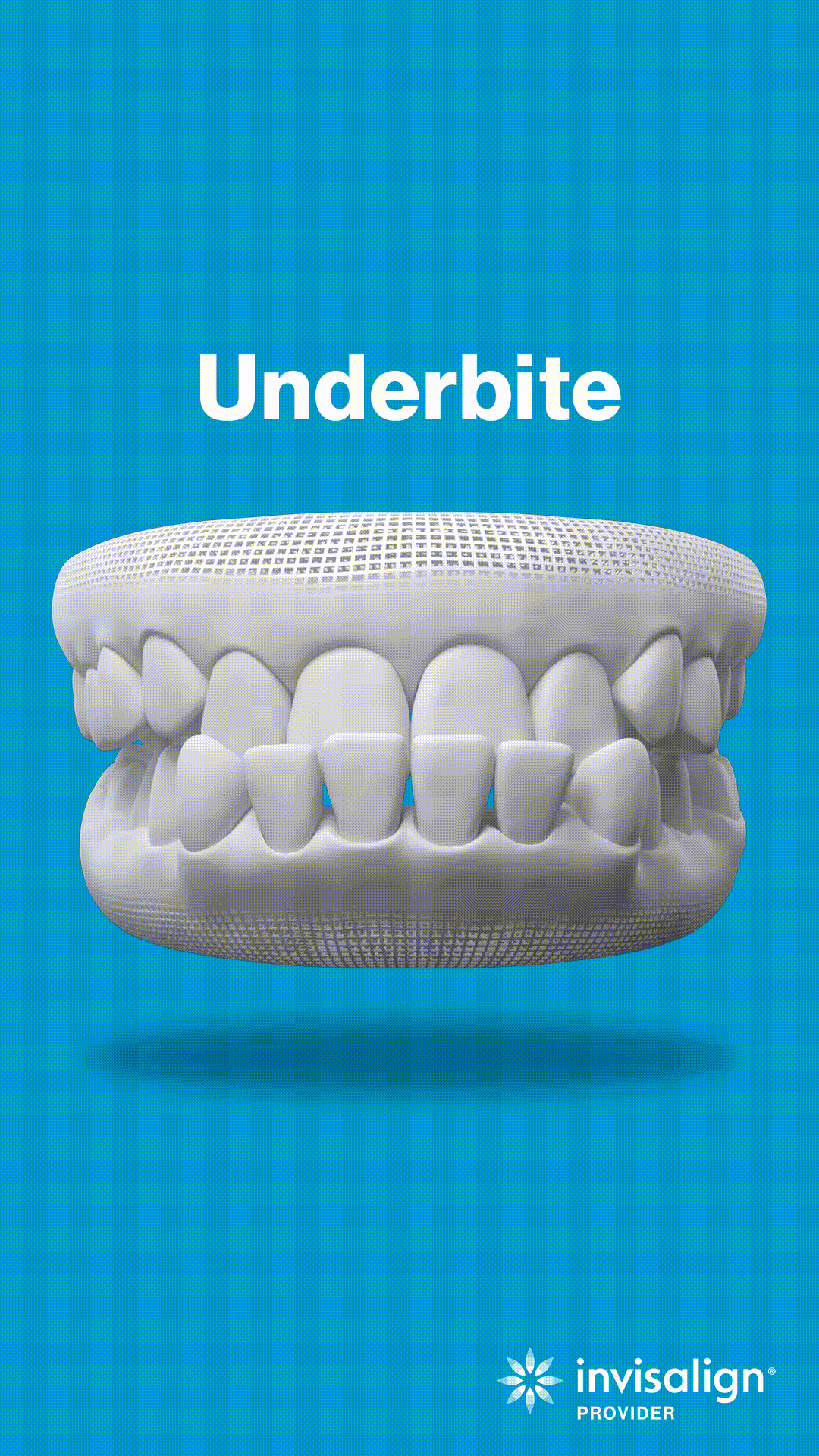 3D dental model showing underbite malocclusion on blue background with Invisalign branding